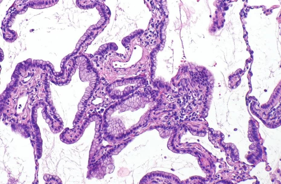 Adenocarcinoma pulmonar.